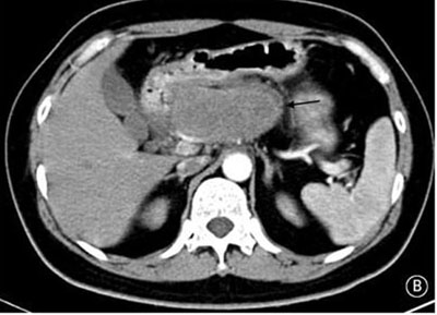 胰高血糖素瘤相關皮疹圖片